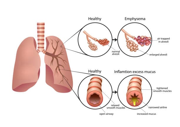 How is chronic bronchitis diagnosed?