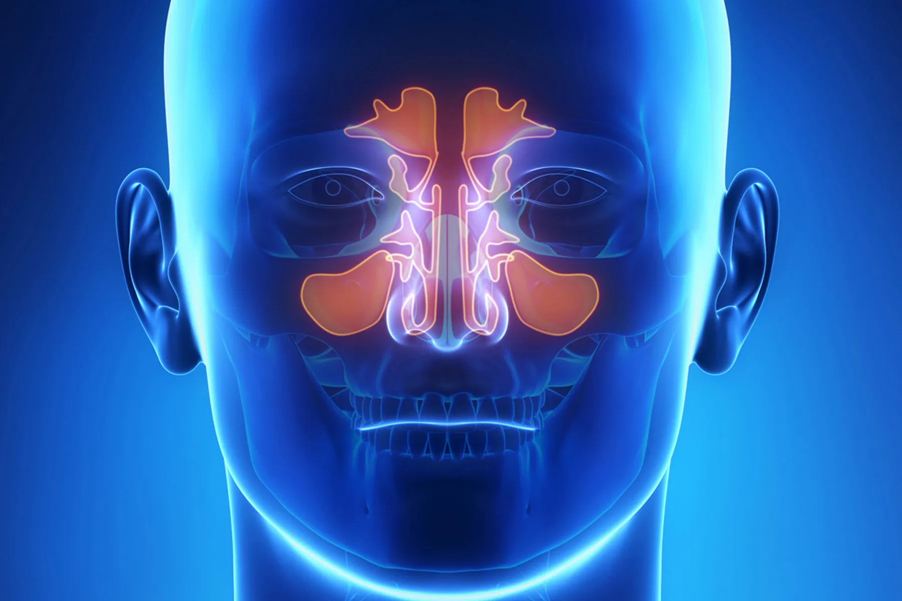 What is Sinusitis?