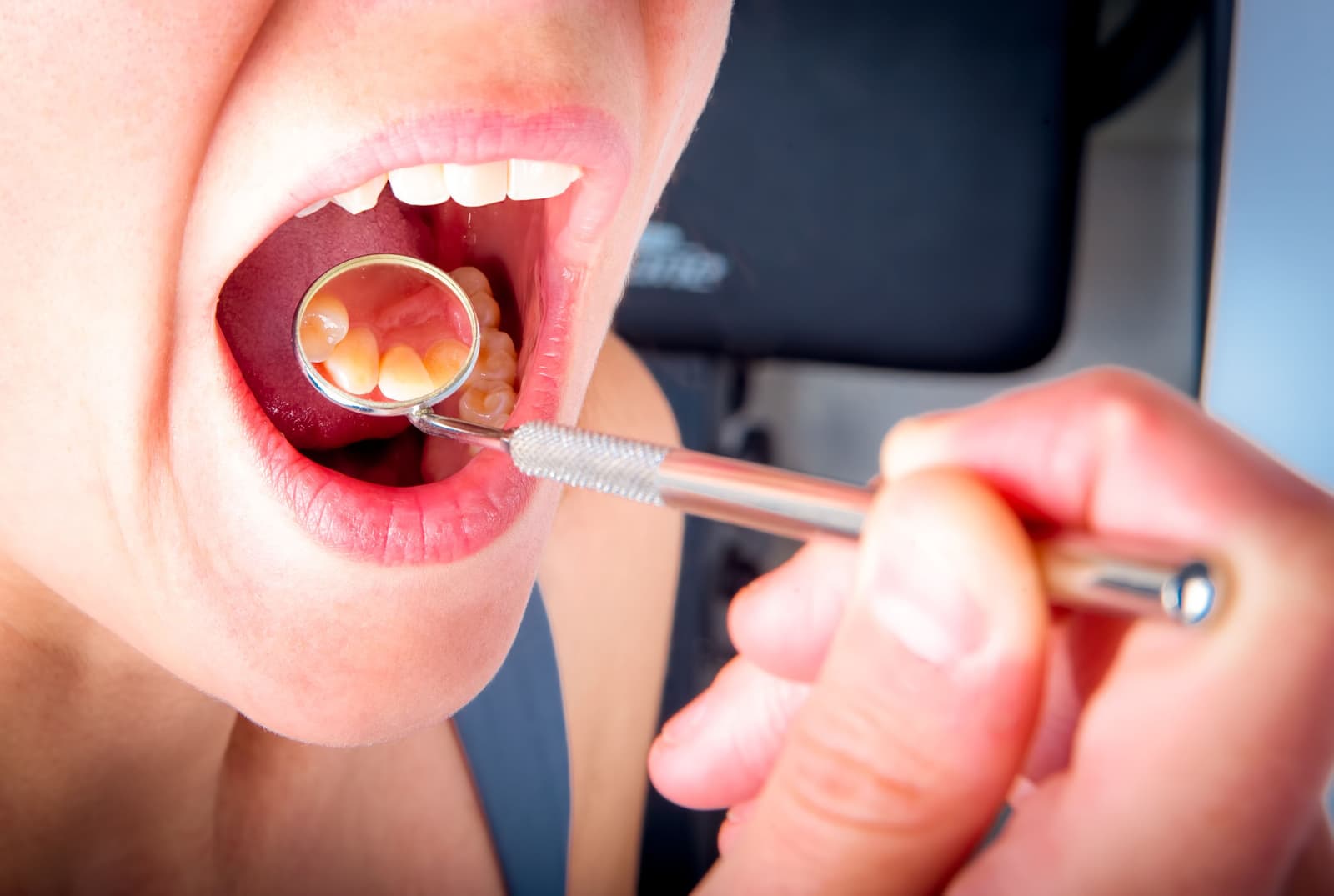 What are the symptoms of periodontal disease?