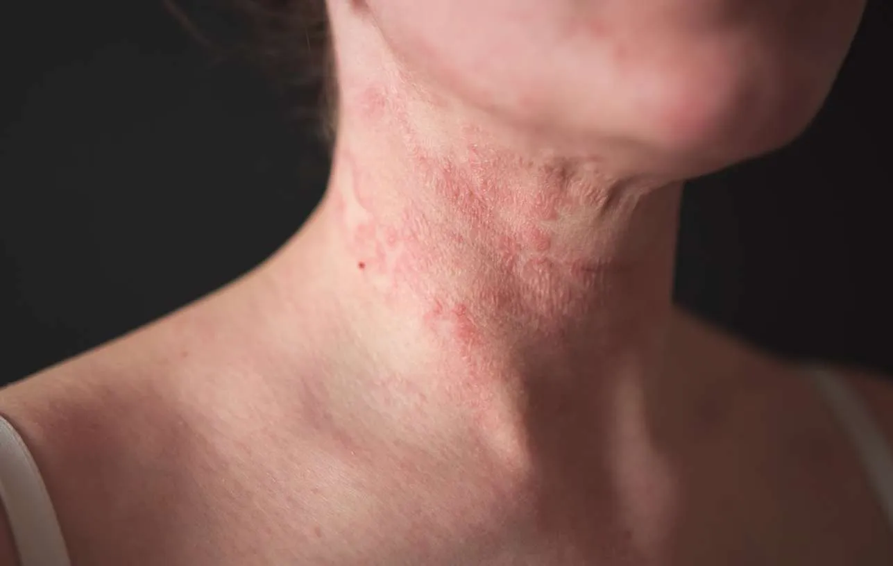 How to prevent an eczema flare-up?