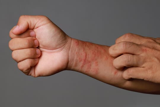What does an eczema flare-up look like?