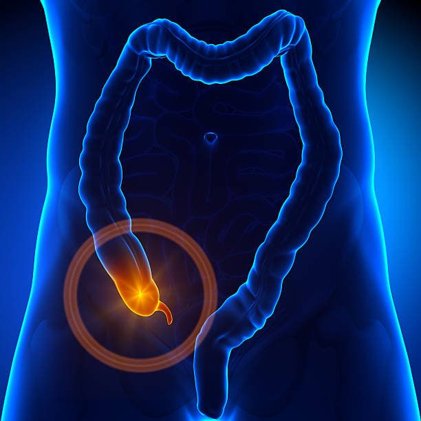 What is an appendicitis?