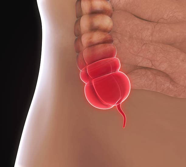 What are the symptoms & causes of appendicitis?