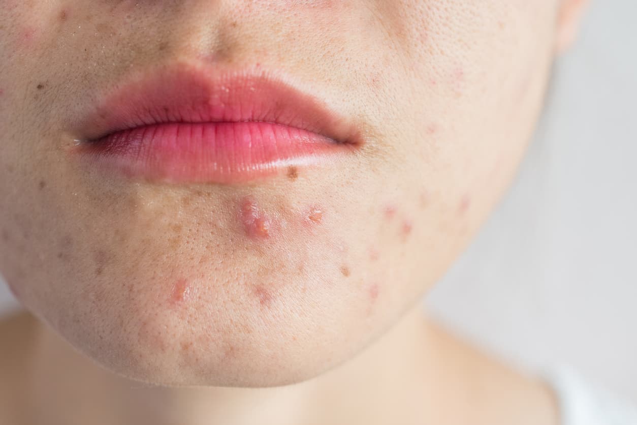 What is acne?