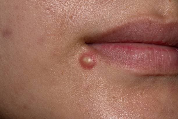 What are the types of acne?