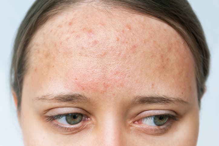 What are the symptoms of acne?