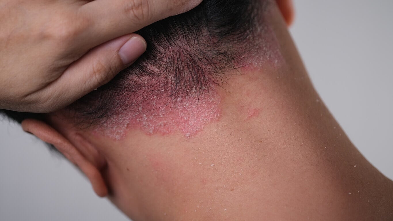 Can psoriasis be treated?