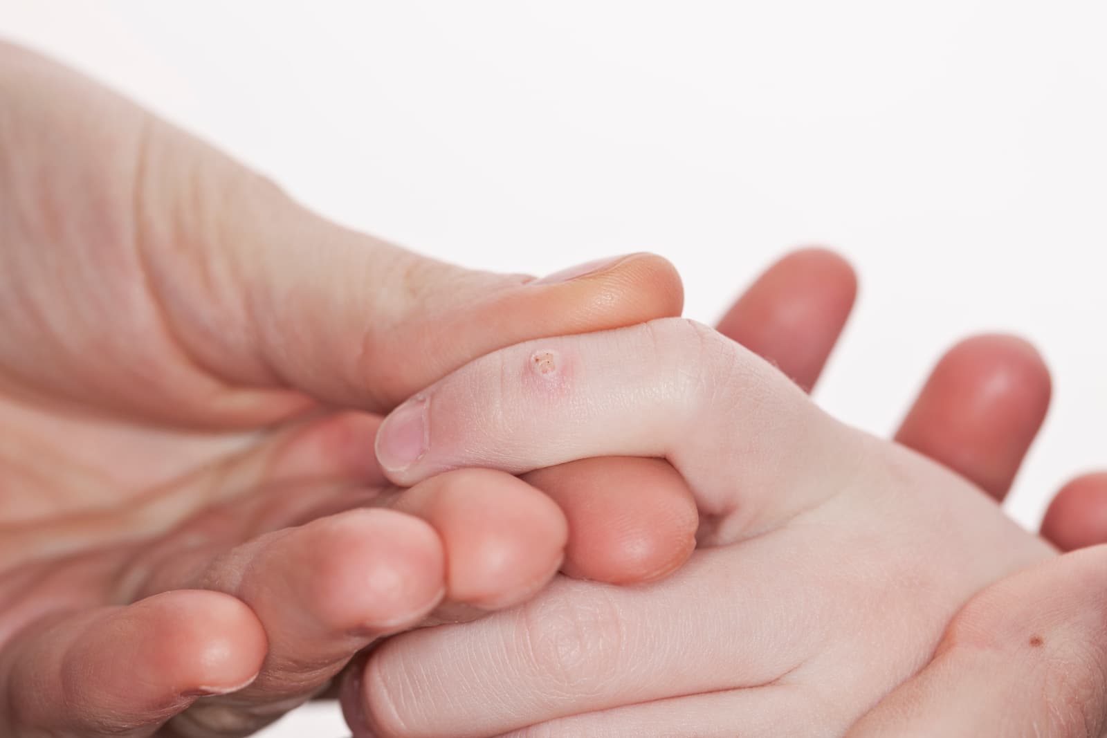 What are warts?