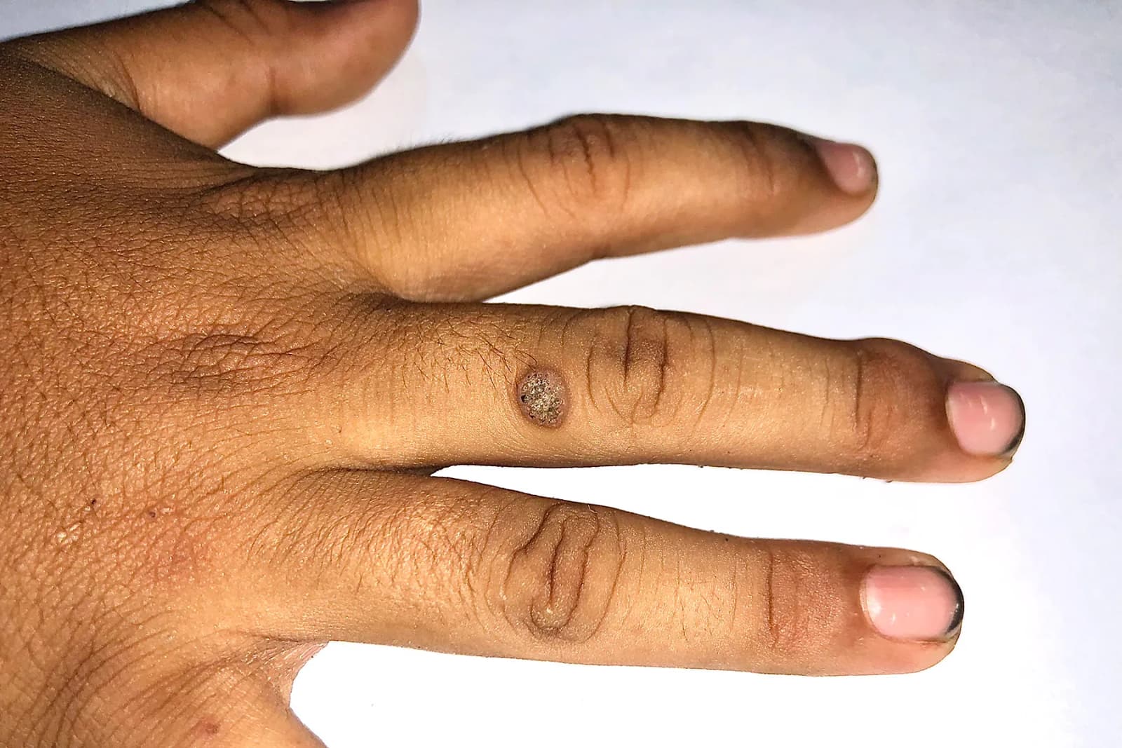 How are warts diagnosed?