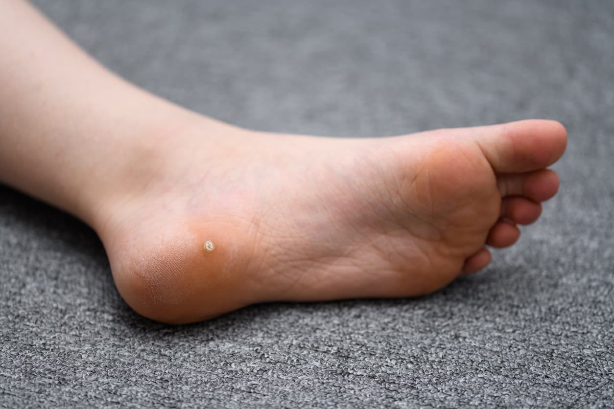 What is the treatment for warts?
