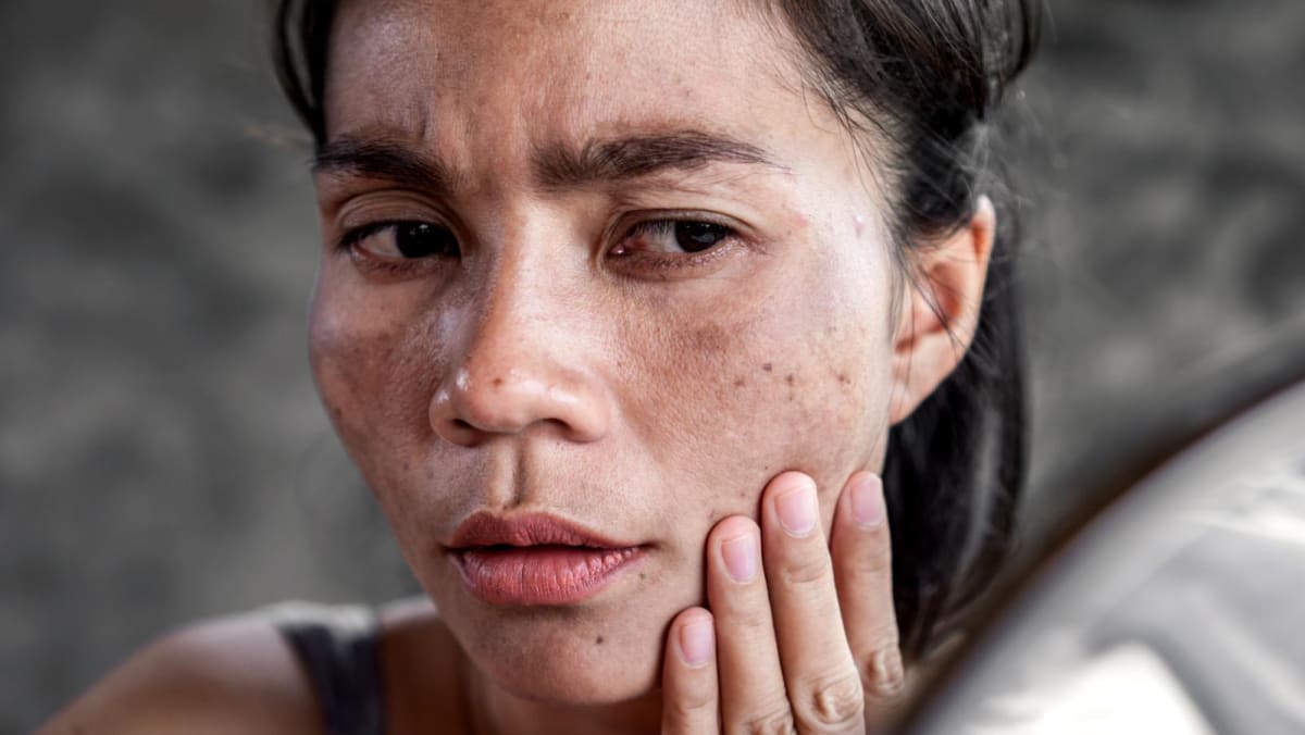 What causes melasma?