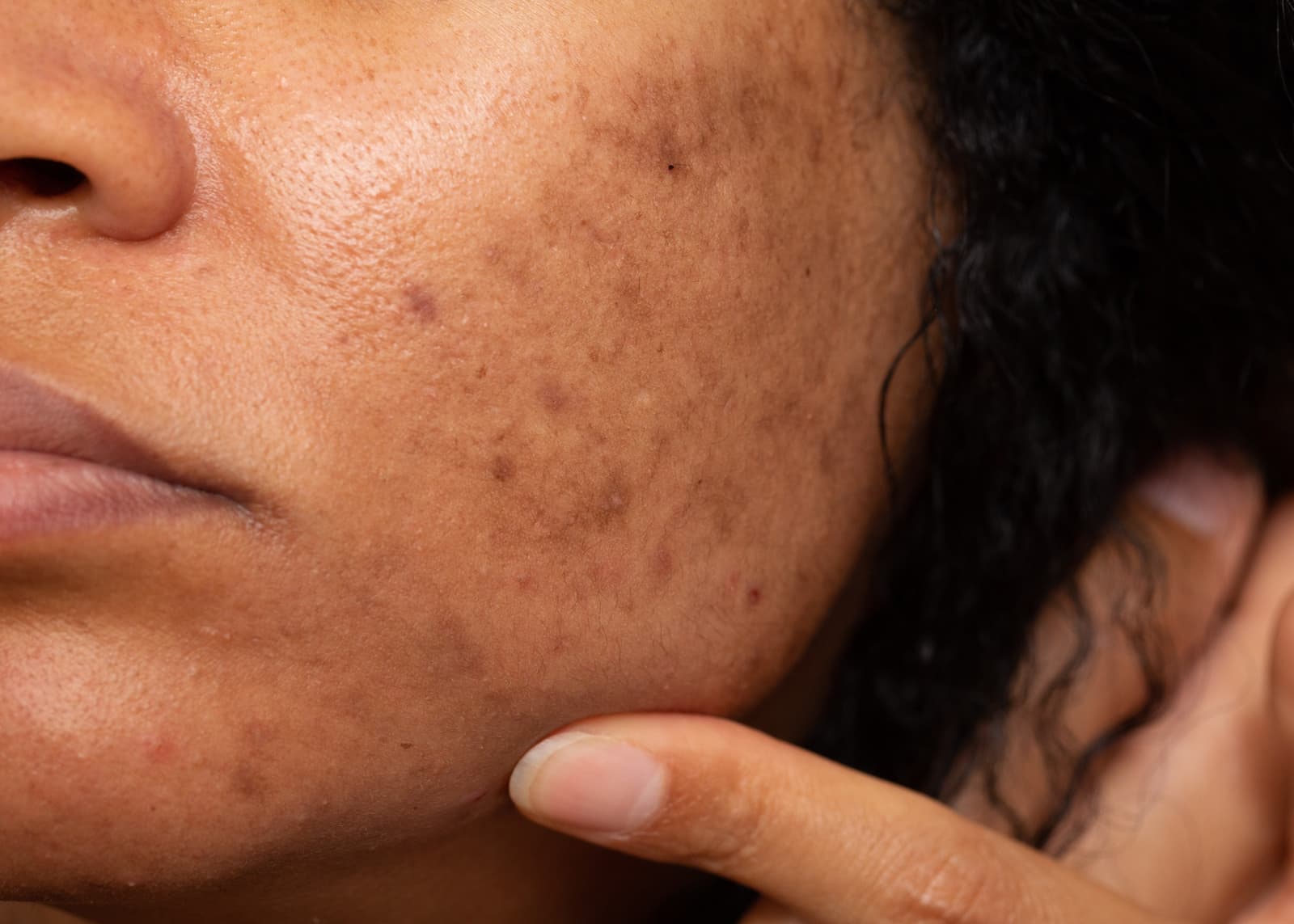 Who is at risk of melasma?
