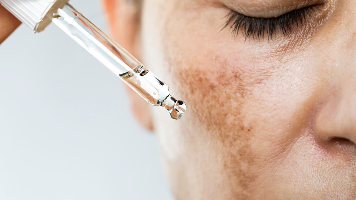 What causes melasma?