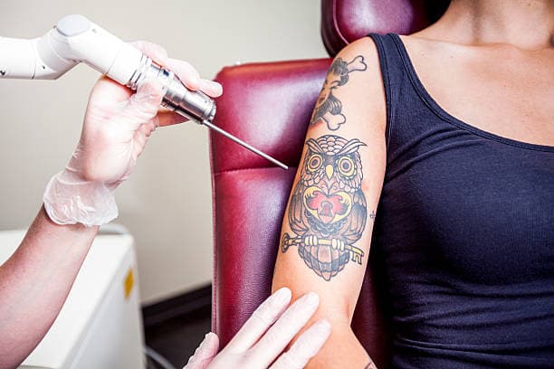What are the types of tattoo removal?