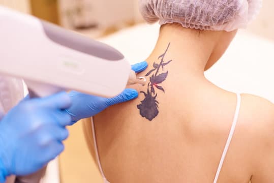 Is tattoo removal safe?