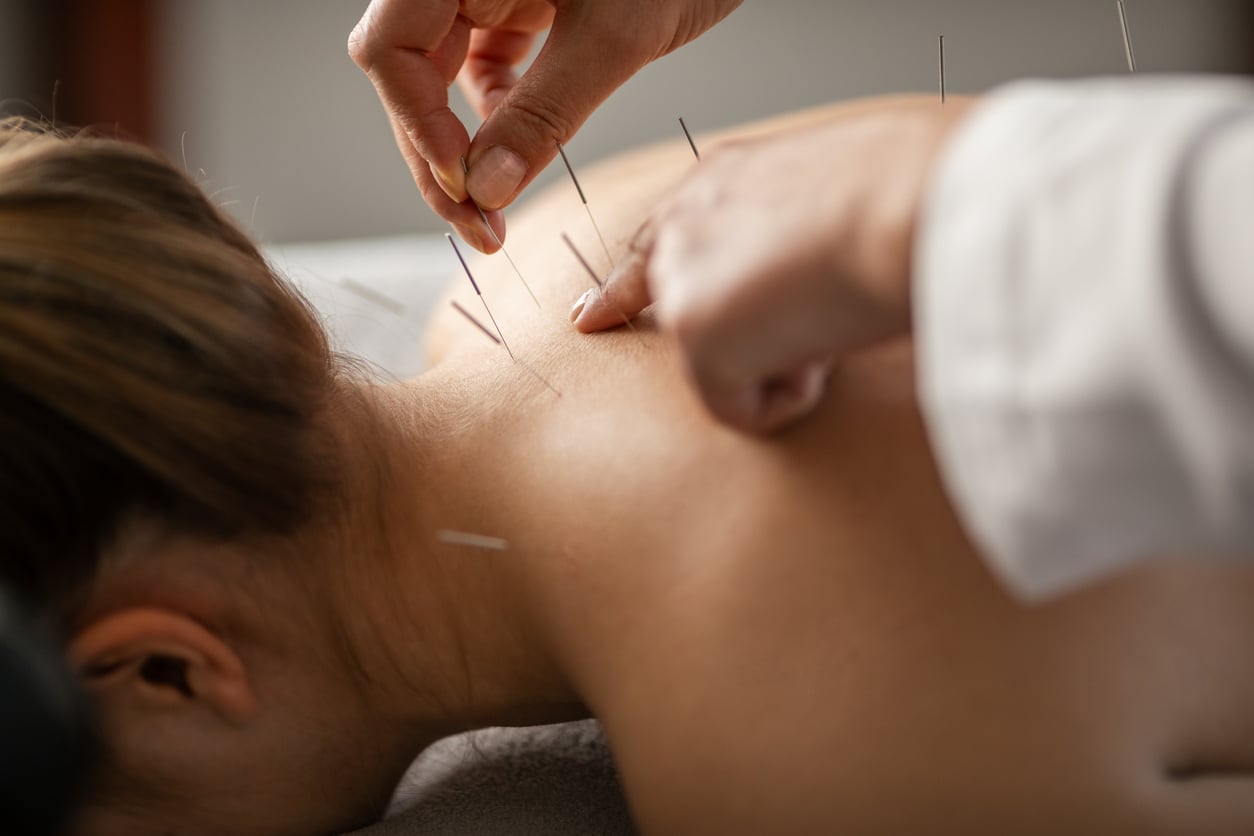 Acupuncture Styles and Techniques
