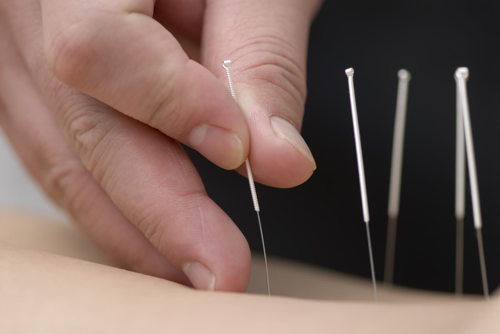 What is acupuncture?