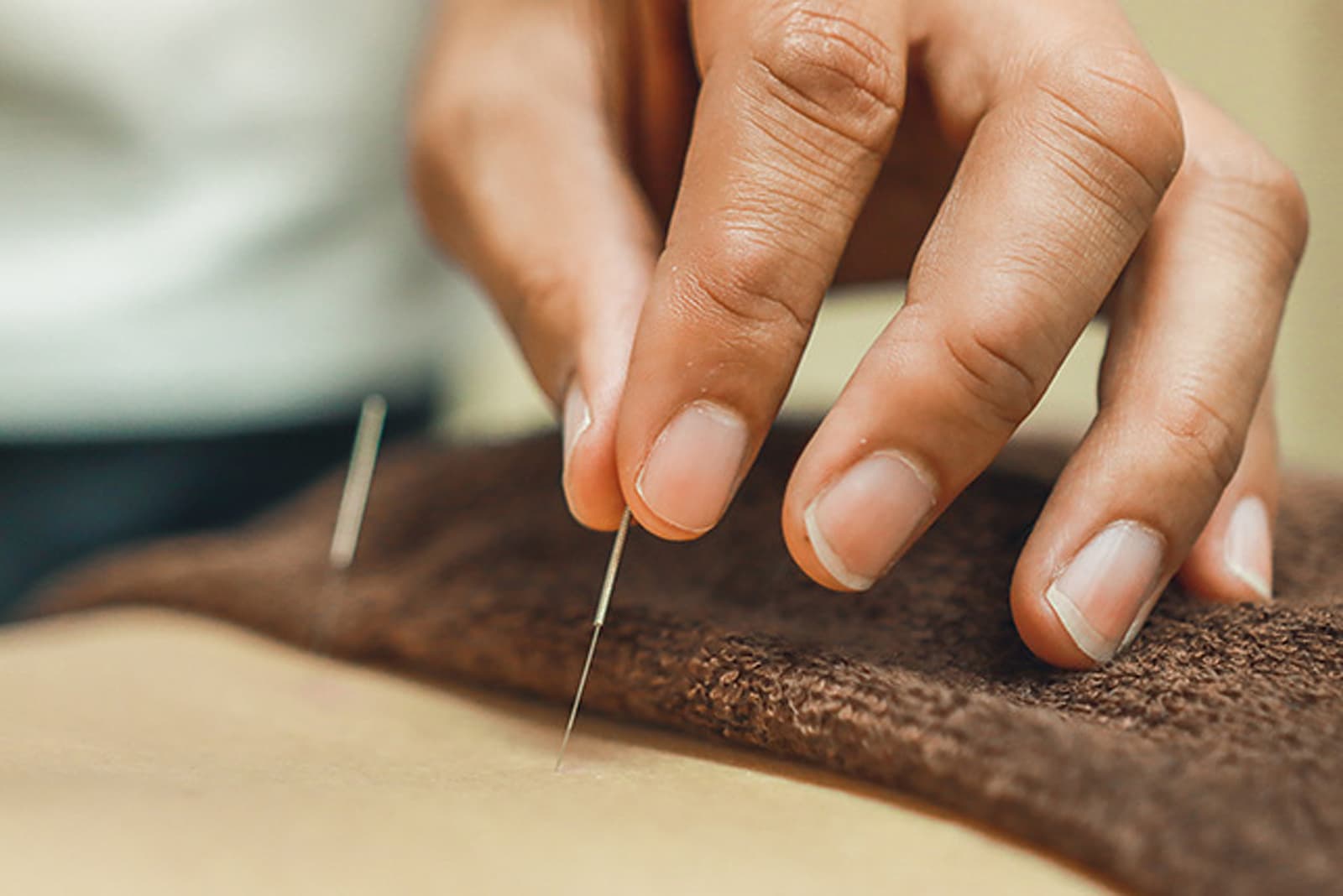 What are the different types of acupuncture?