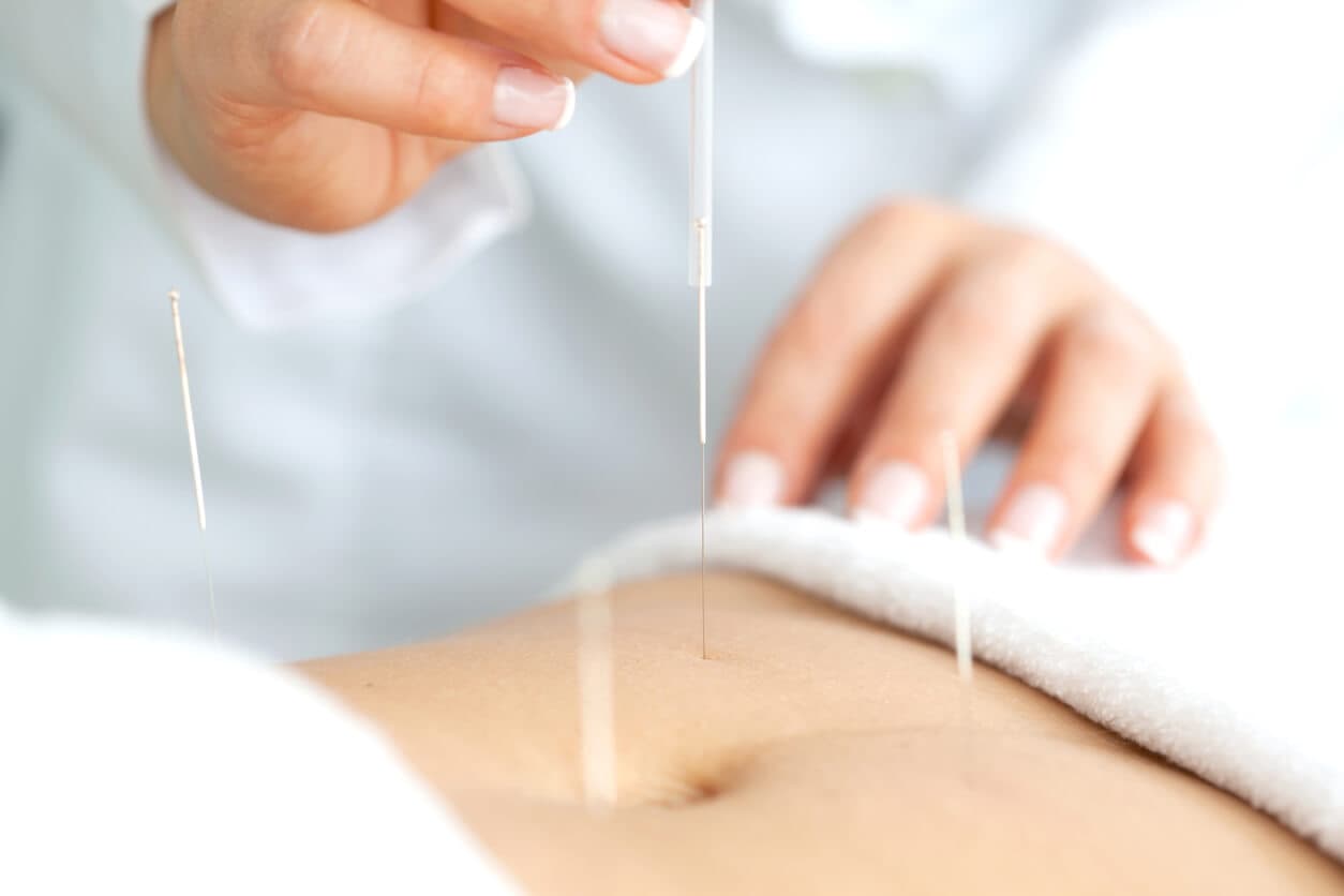 Which Type of Acupuncture is right for me?