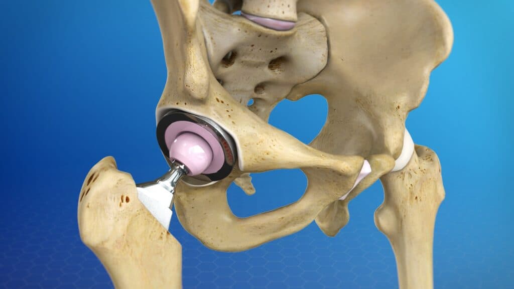 What is a hip replacement surgery?