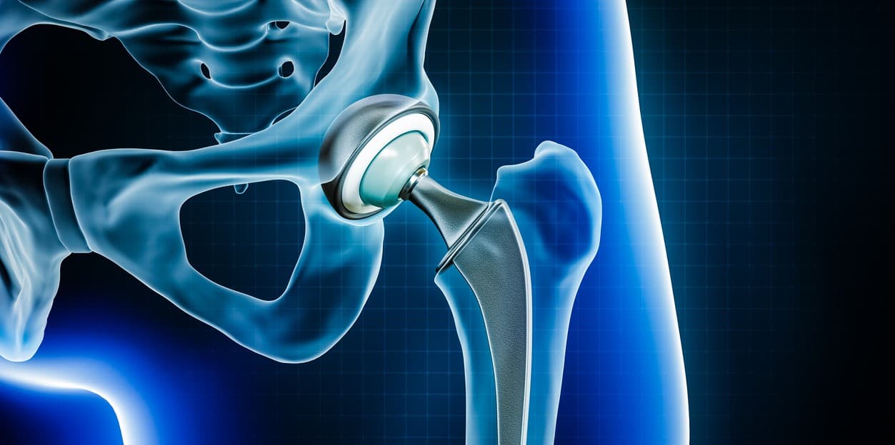 Hip replacement surgery recovery process
