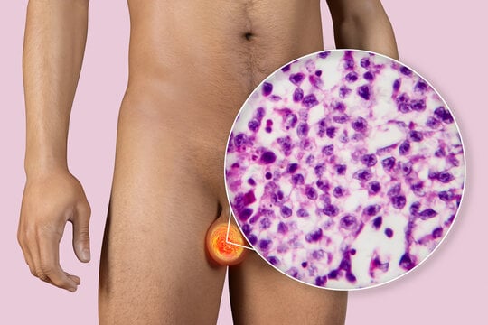 What is an Orchiectomy?