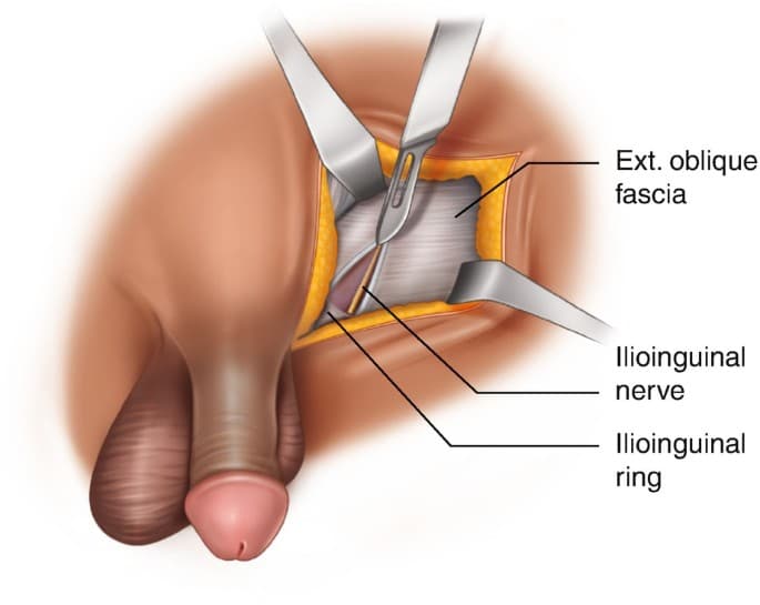 Why do people get an orchiectomy?