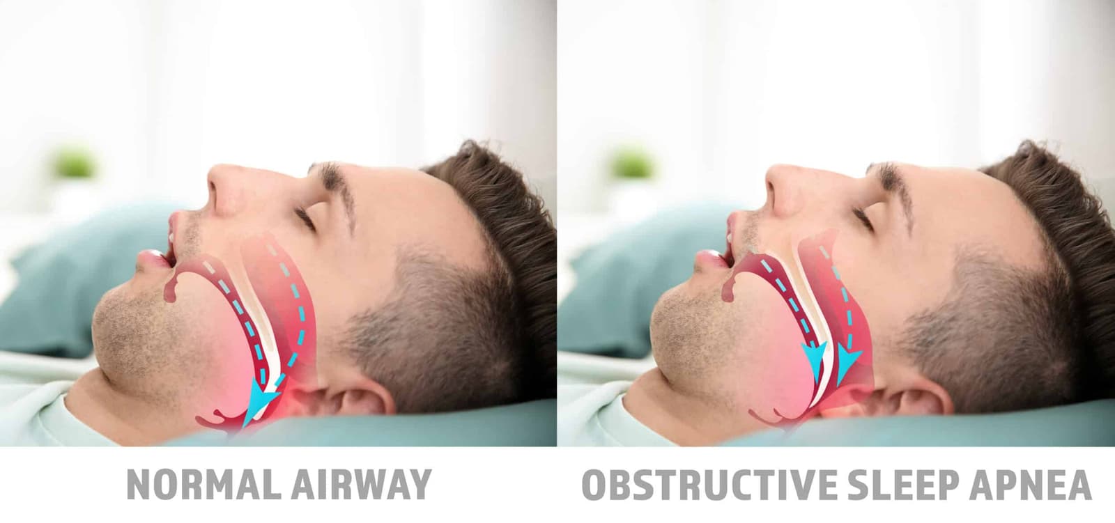 Surgical treatments for snoring