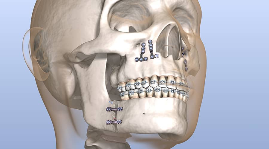 What is corrective jaw surgery?