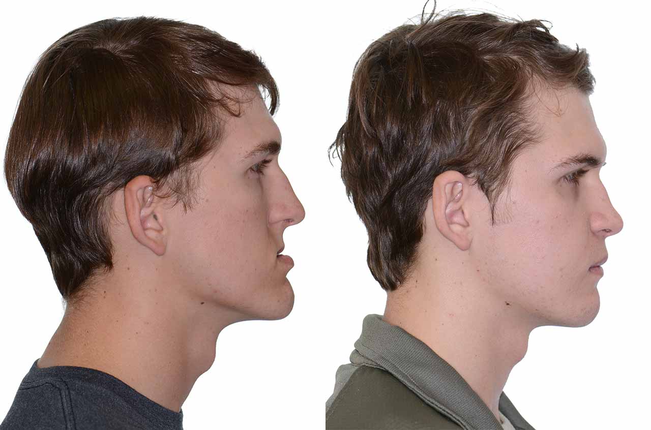 What are the risks & benefits of Orthognathic surgery?