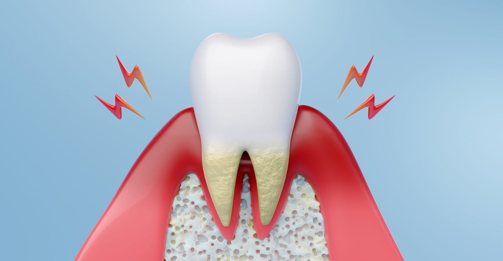Types of Periodontal Disease