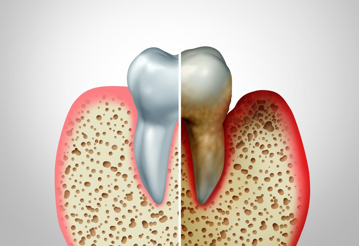 What are periodontal diseases?
