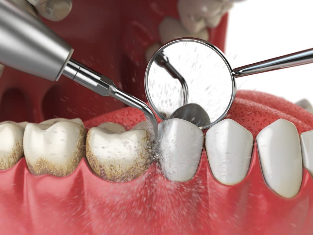 What causes periodontal diseases?