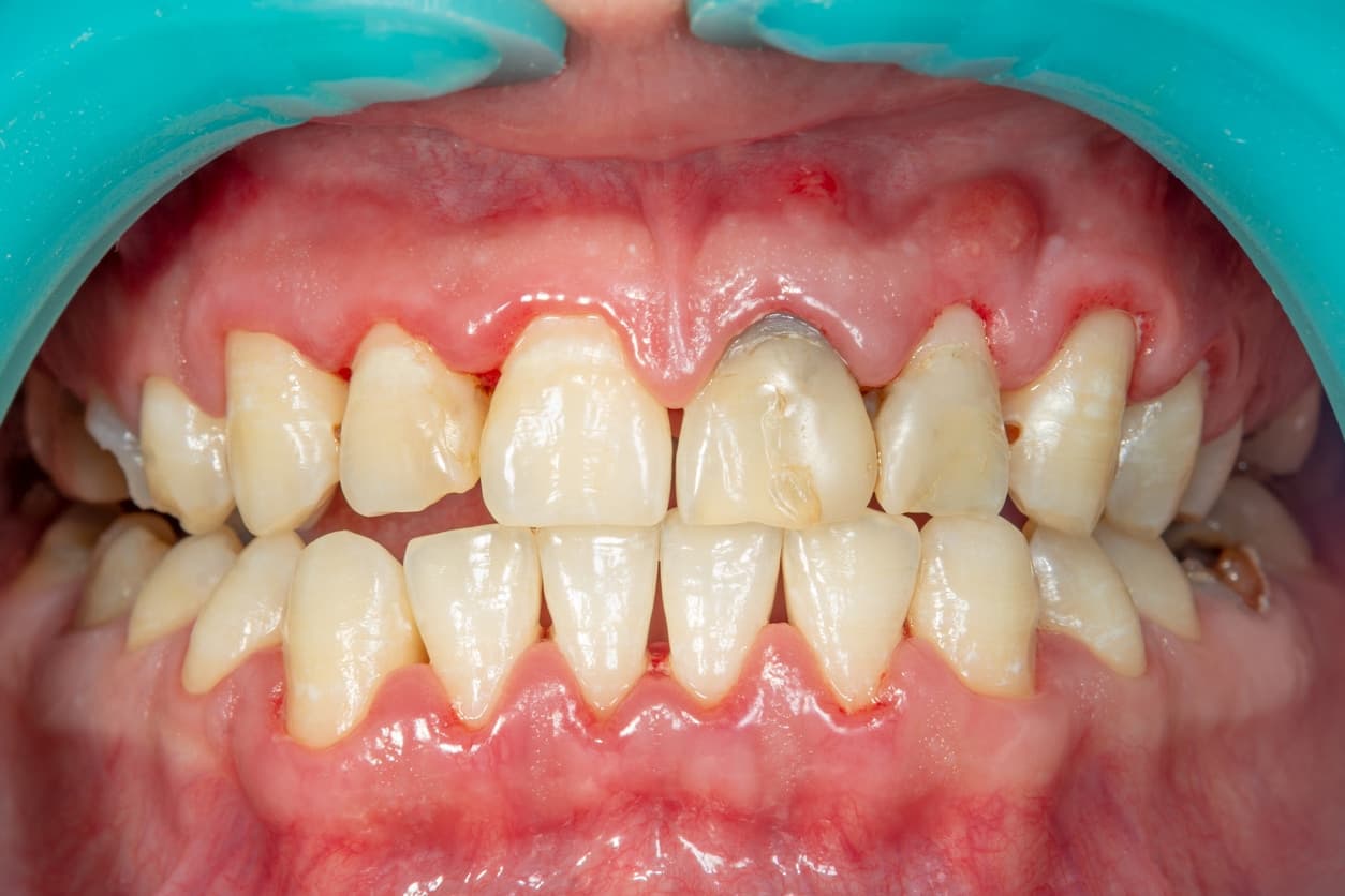 What are the symptoms of periodontal diseases?