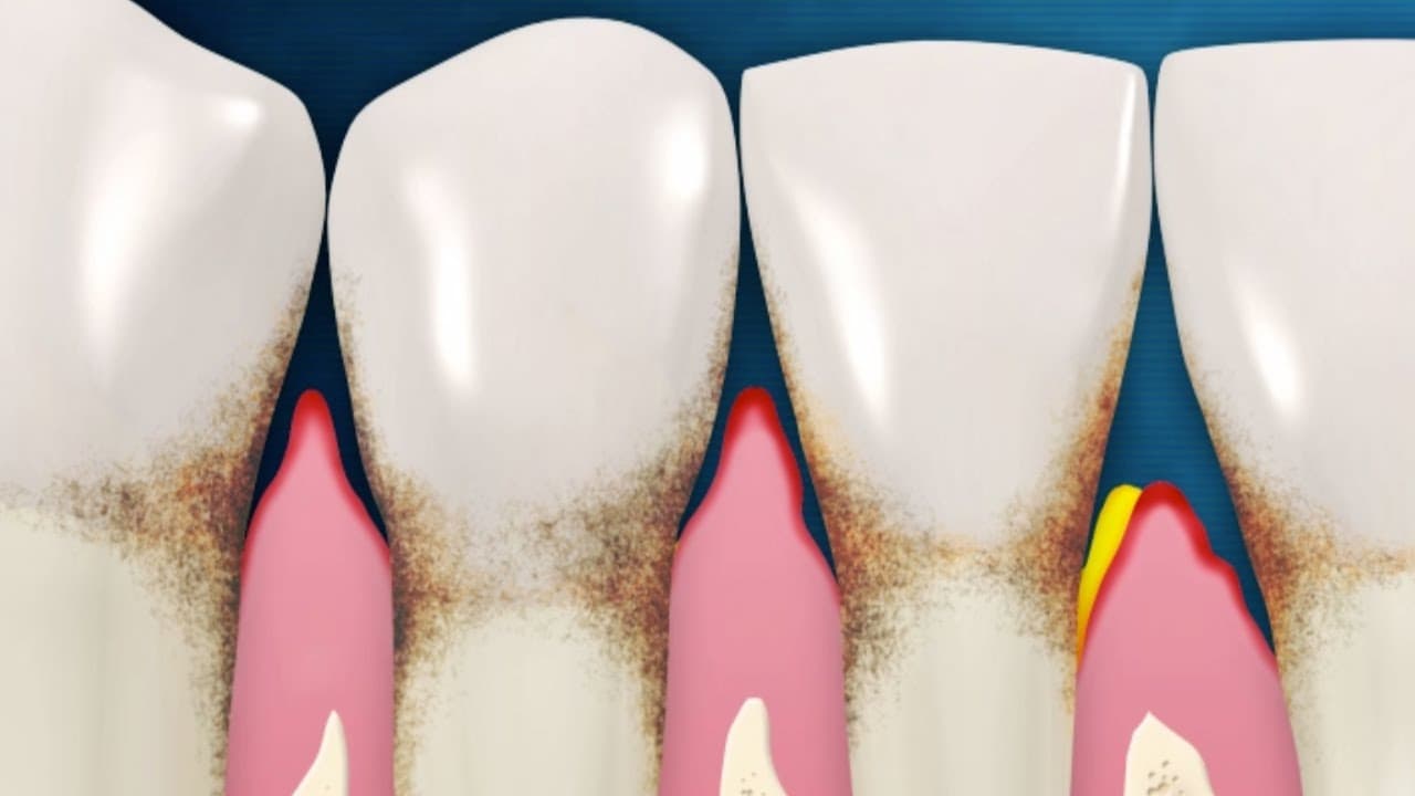 How are periodontal diseases treated?