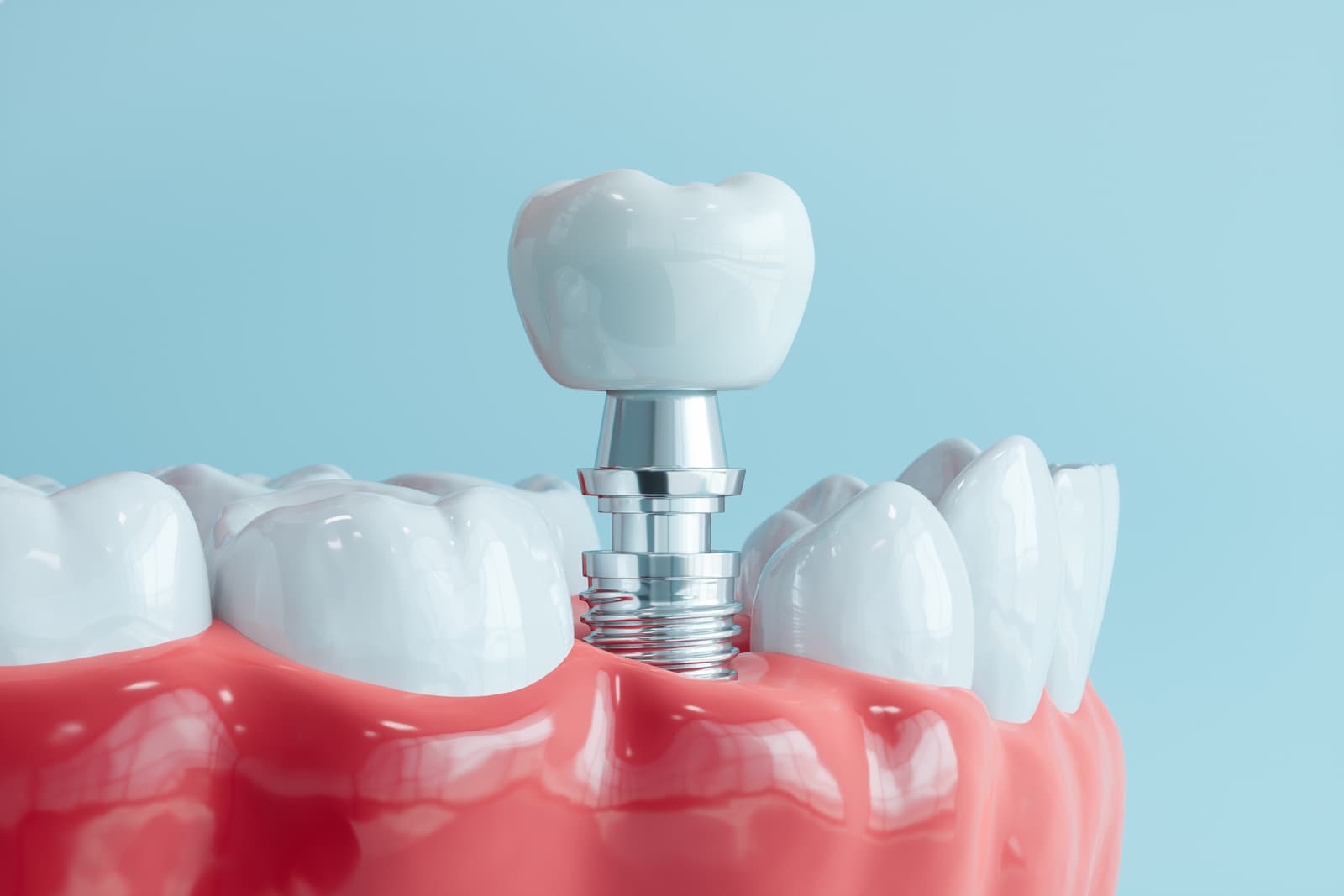 What are dental implants?