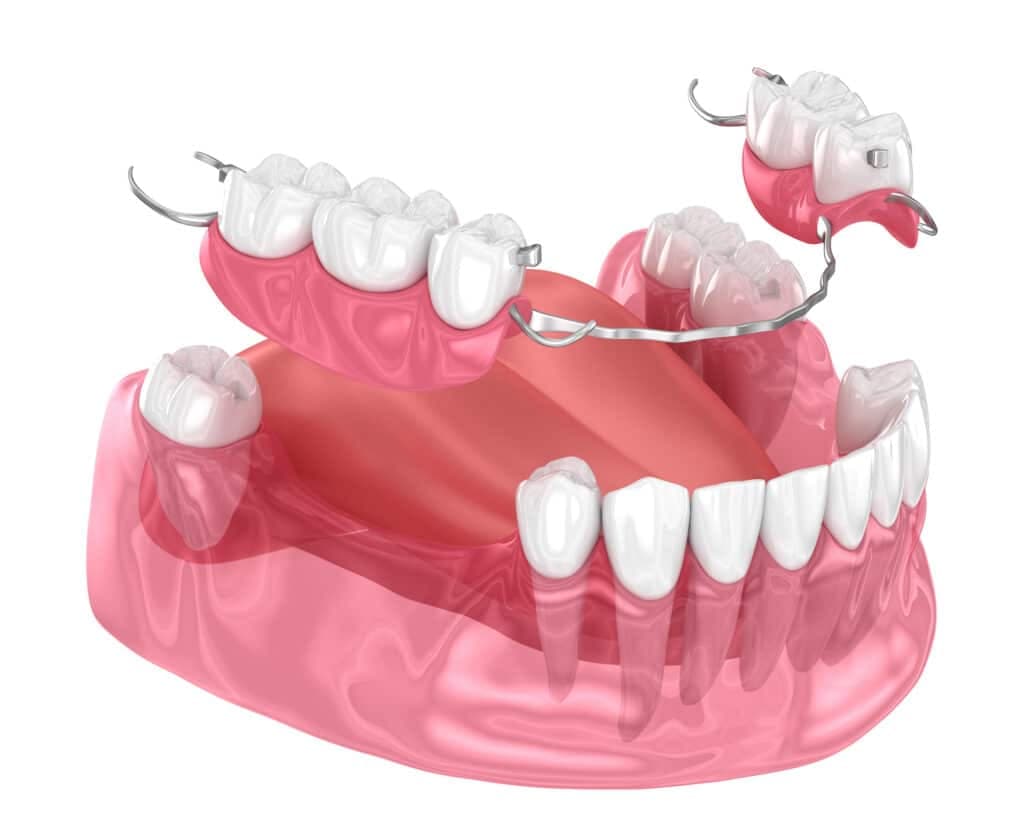 What are the advantages of dentures?