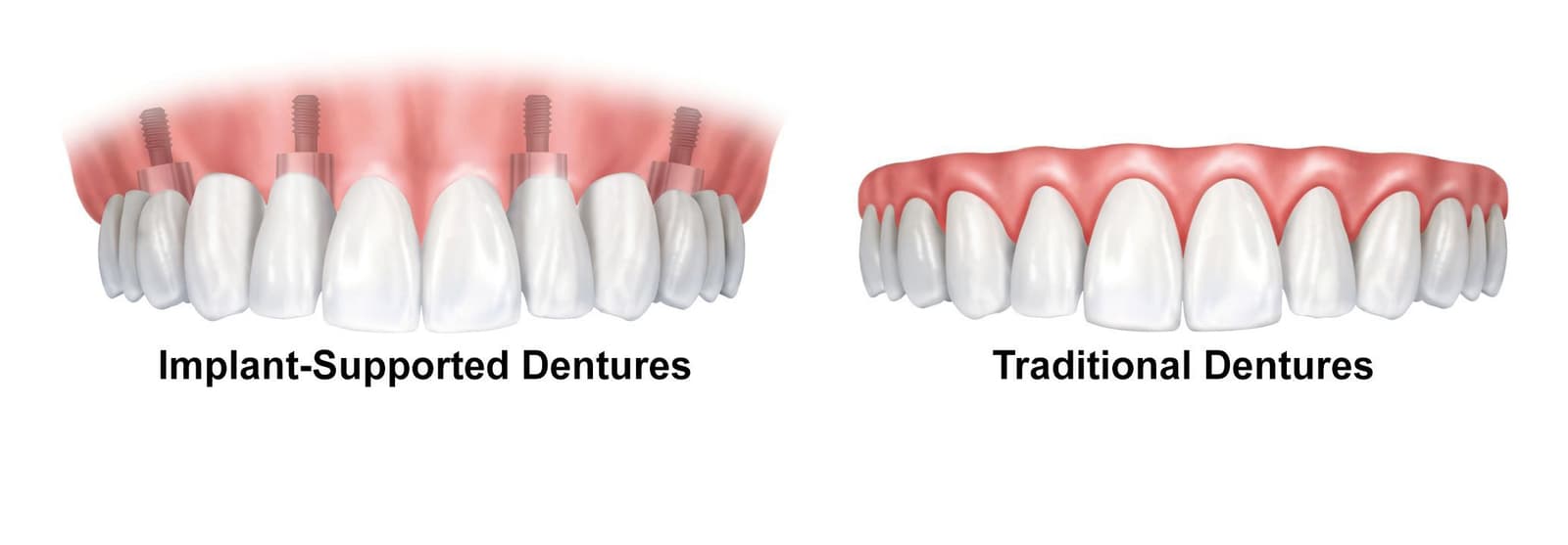 Is it better to have dentures or implants?