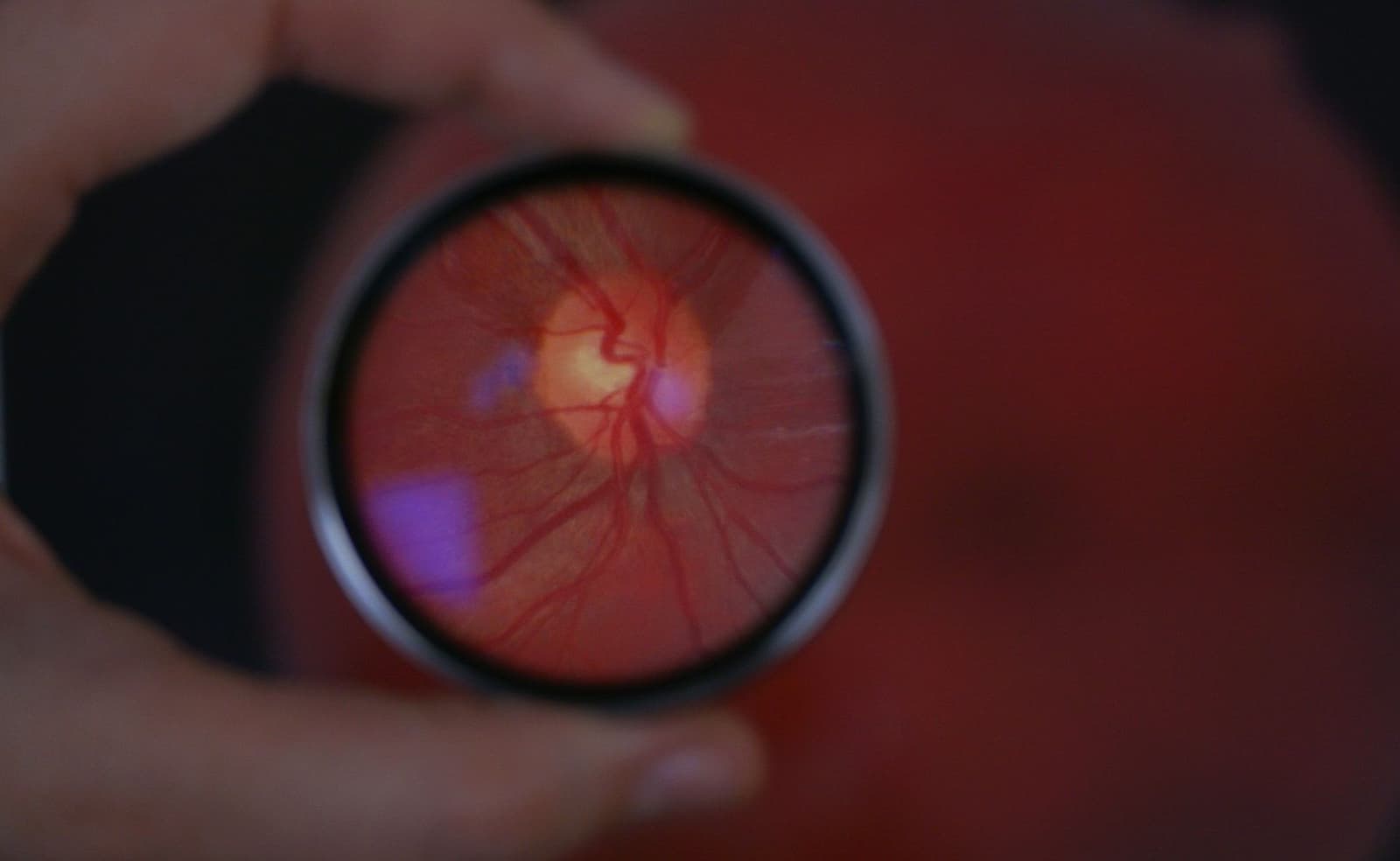 What is dacryocystorhinostomy?