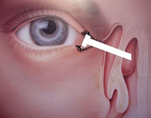 Blocked tear duct surgery recovery