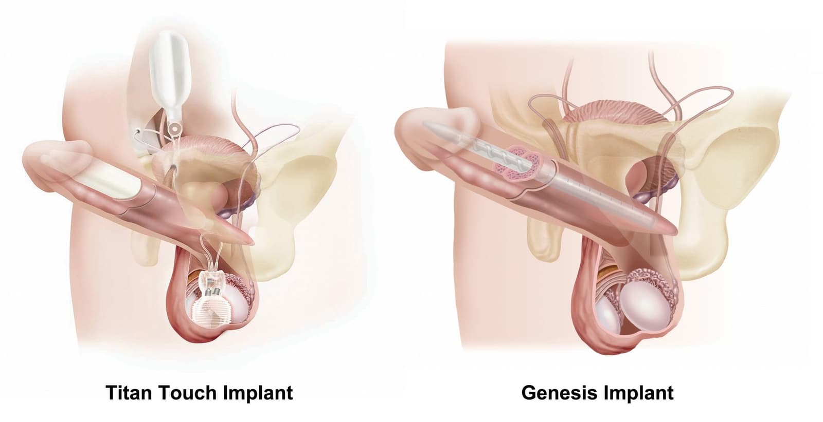 What are the risks or complications of penis enlargement procedures?