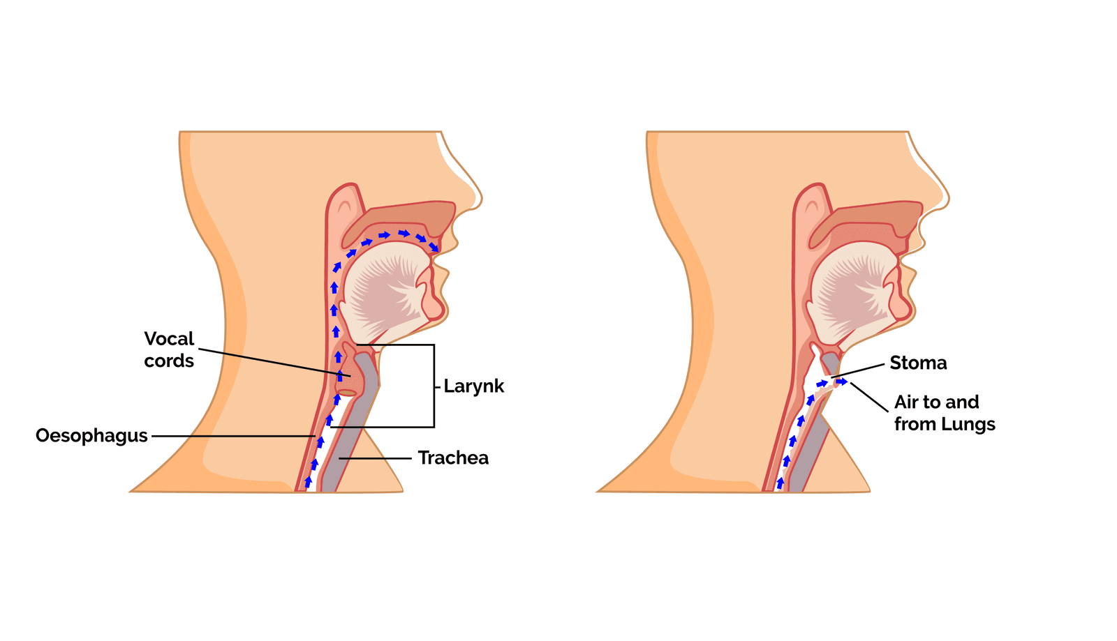 What happens before & during a laryngectomy?