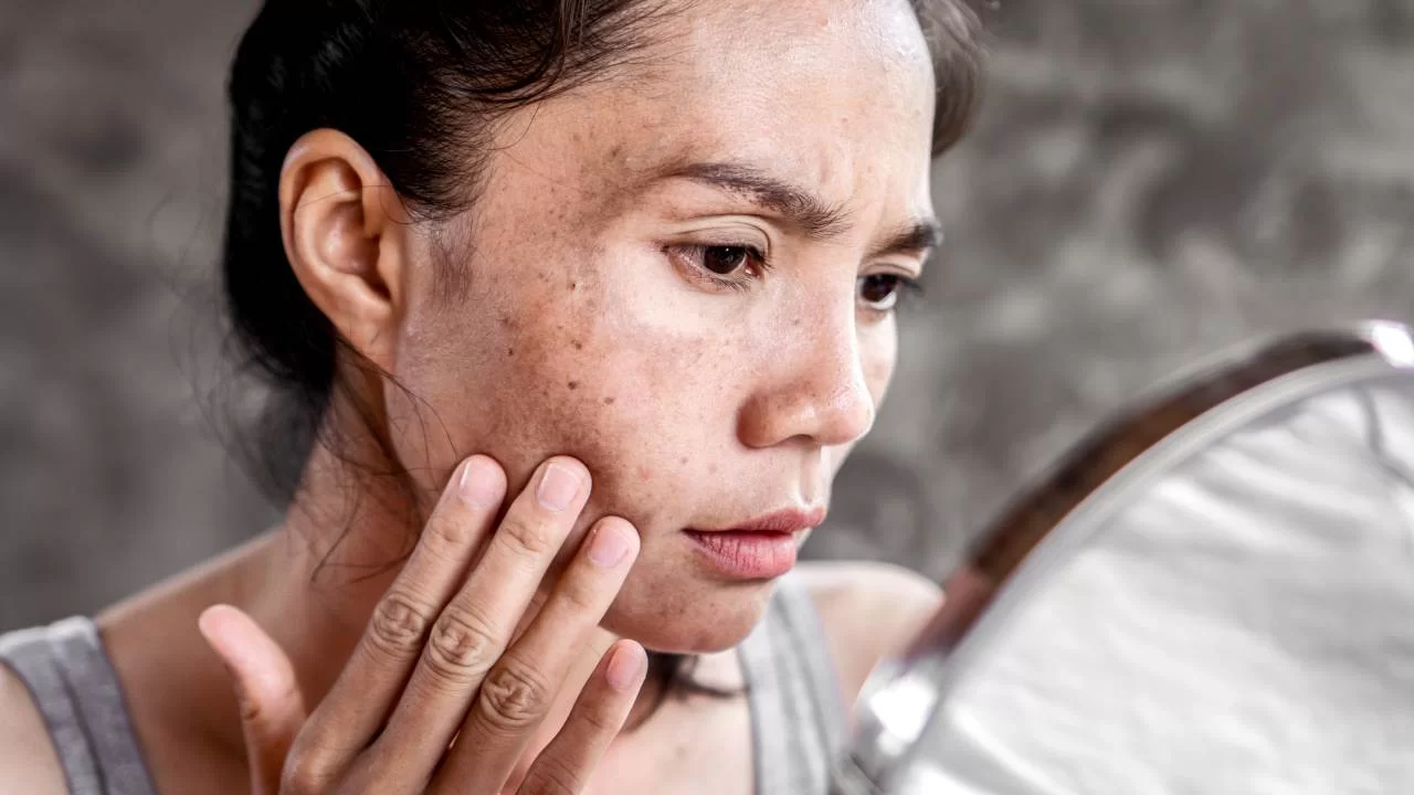 How to avoid melasma from occurring?