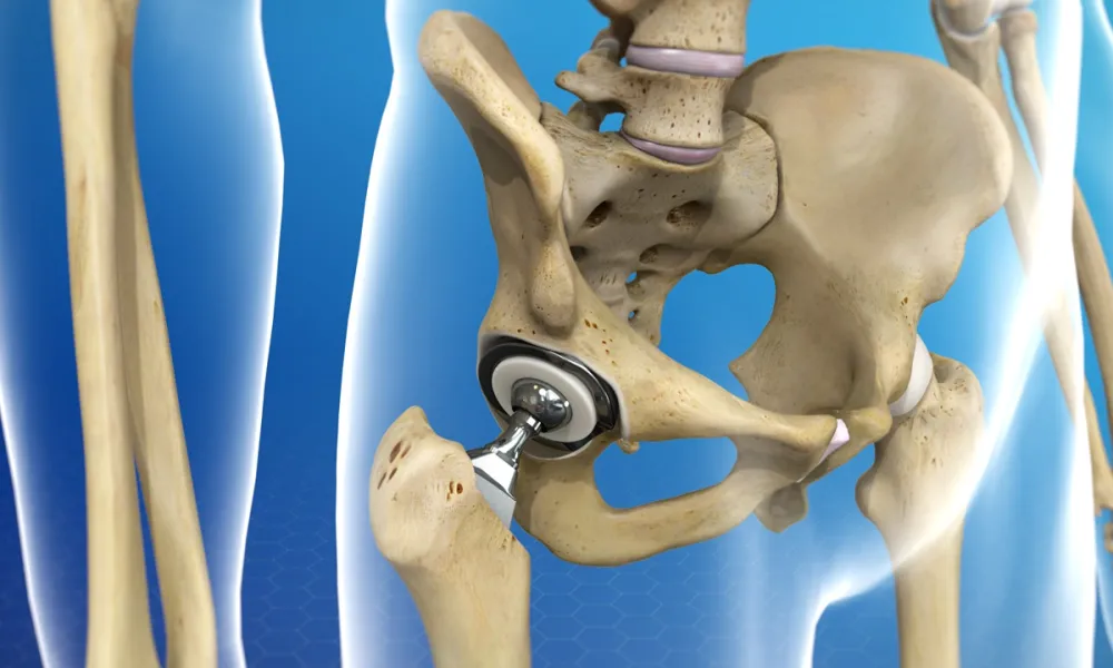 What are the types of hip replacement approaches?