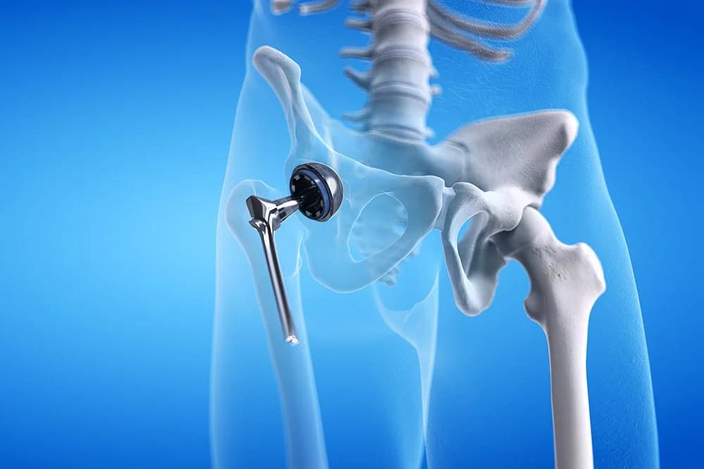 What type of hip replacement implant is best?