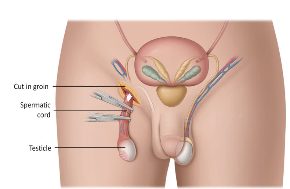 How to prepare for an orchiectomy?