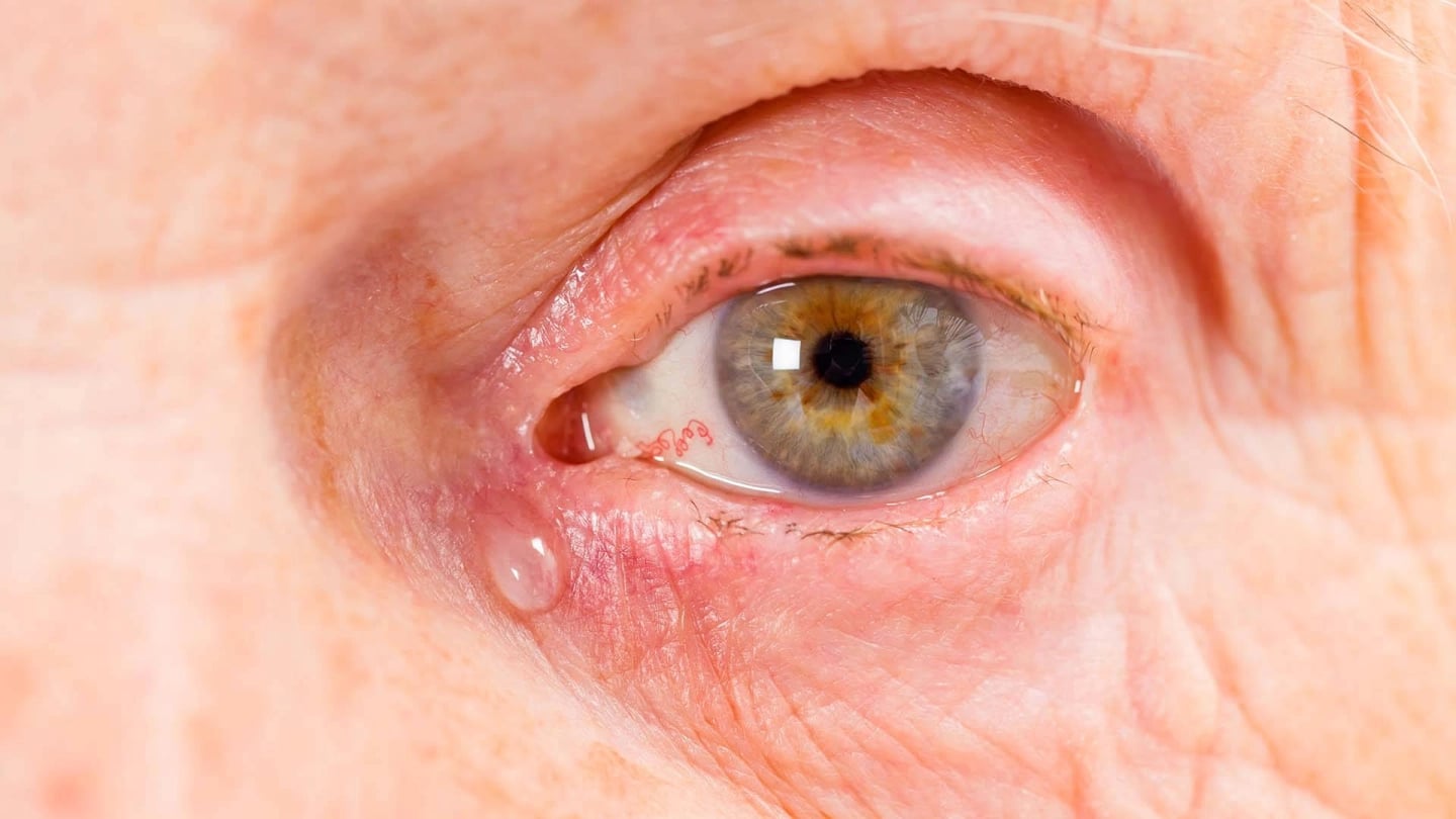 What is tear duct surgery?