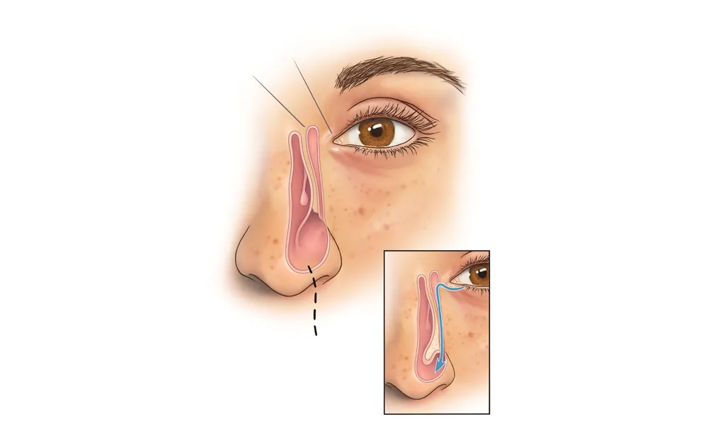 Causes of a blocked tear duct