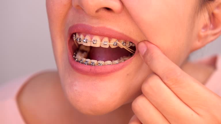 Types of Orthodontic Appliance