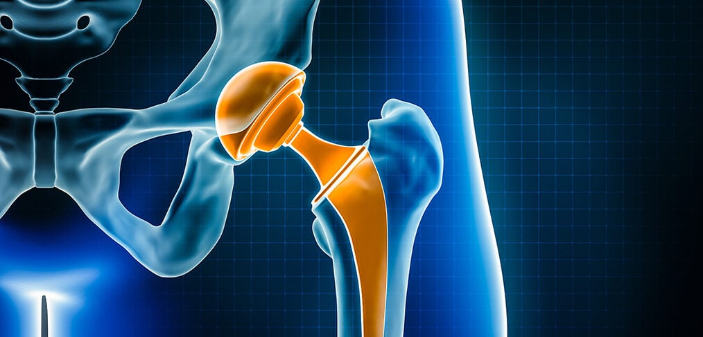 What to know about a hip arthroplasty